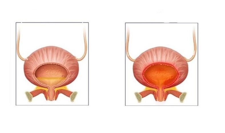 Normaal en patiënten met cystitis van de urinewegen