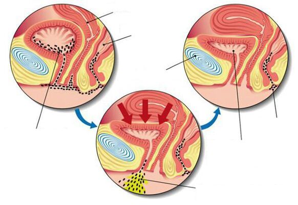 bacteriën in de blaas bij blaasontsteking